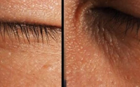 Effective Ways to Remove Skin Tags at Home