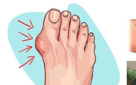 Harness the Natural Power of Artichoke and Lemon Water to Combat Gout and Lower Uric Acid Levels