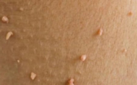 Easy Home Remedies for Skin Tags and Plantar Warts