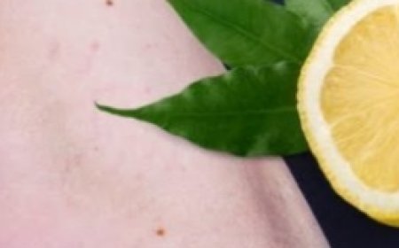 Lemon Removes Varicose Veins! Just Do This Every Day…