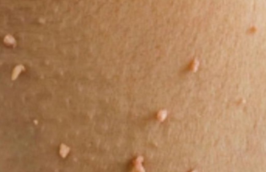 Easy Home Remedies for Skin Tags and Plantar Warts