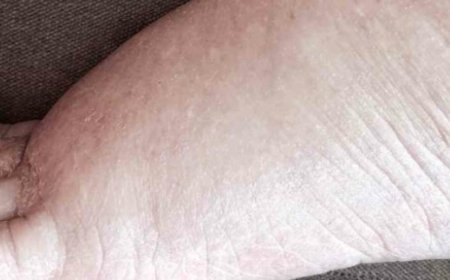 Here’s How to Eliminate Excess Water from Your Body, and It Also Helps with Weight Loss