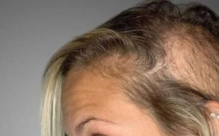 Didn’t Expect This! The Hair on My Bald Spot is Growing Like Crazy! 100% Efficiency!