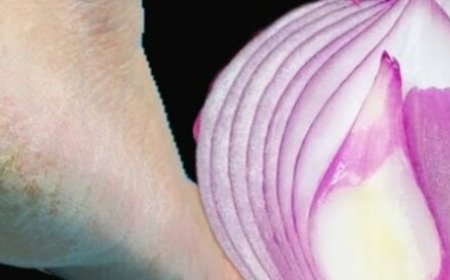 Remove Cracked Heels and Get Beautiful Feet Forever: A Magical Home Remedy with Red Onion