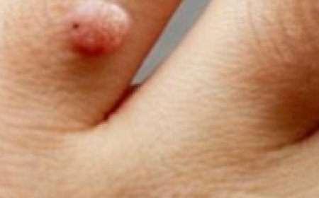 How to Remove Skin Tags and Warts Overnight: Safe and Effective Methods