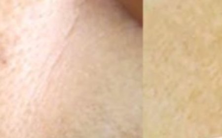  Erased My Age Spots With a Cheap Kitchen Ingredient: Baking Soda