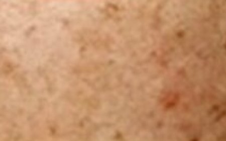 Shocking ????She Wiped the Dark Spots Off Her Face with Potatoes and Ginger in Just 20 Minutes