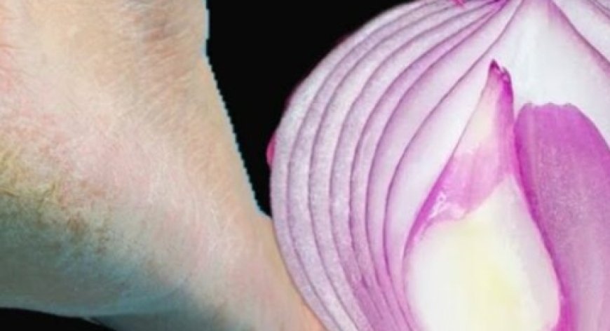 Remove Cracked Heels and Get Beautiful Feet Forever: A Magical Home Remedy with Red Onion