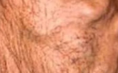 AM SHOCKED! Instantly Dissolves Blood Clots and Makes the Blood Fluid with Apple and Lemon Juice!