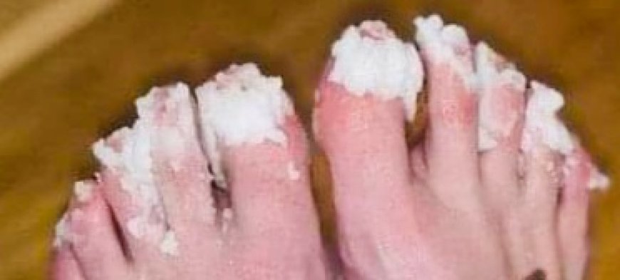 Natural Remedy for Nail Fungus: Effective Treatment for Quick Relief