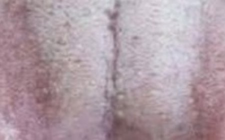 Understanding the Causes of a White Tongue: What Your Tongue May Be Telling You